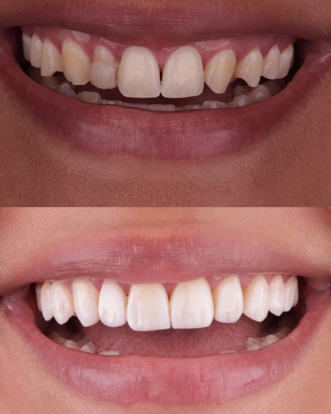 Transformação do Sorriso (antes e depois)